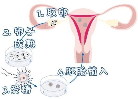 代生捐卵生子